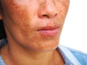 melasma