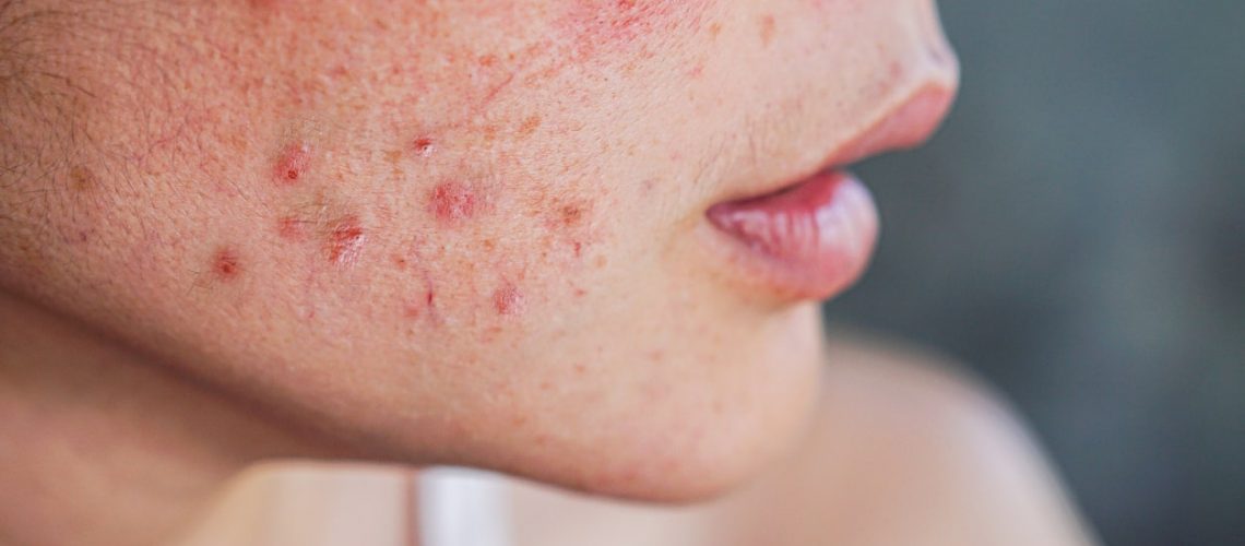 Acne