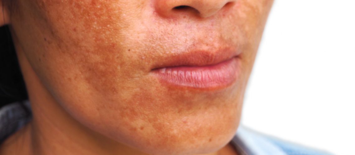 melasma