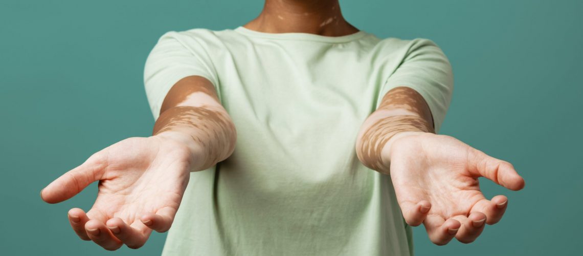 Vitiligo